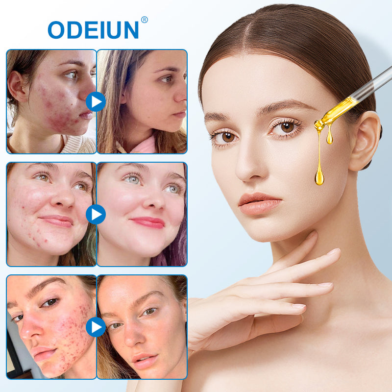 5 Weeks to Flawless Skin 😍 ODEIUN® Anti-Imperfection Serum Transforms Acne and Dark Spots! 💫✨ - 1 x 30 ml